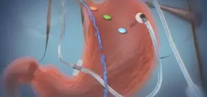 Un implant aide à suivre et contrôler l’estomac des patients obèses