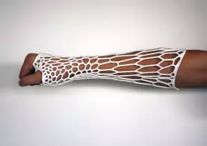 Un plâtre imprimé en 3D qui s’adapte à chaque fracture