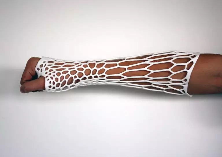 Un plâtre imprimé en 3D qui s’adapte à chaque fracture